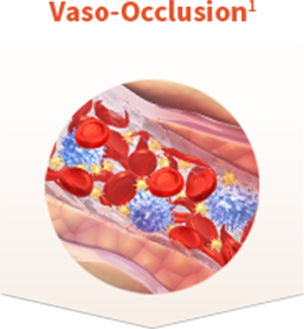 Vaso-occlusion and Anaemia