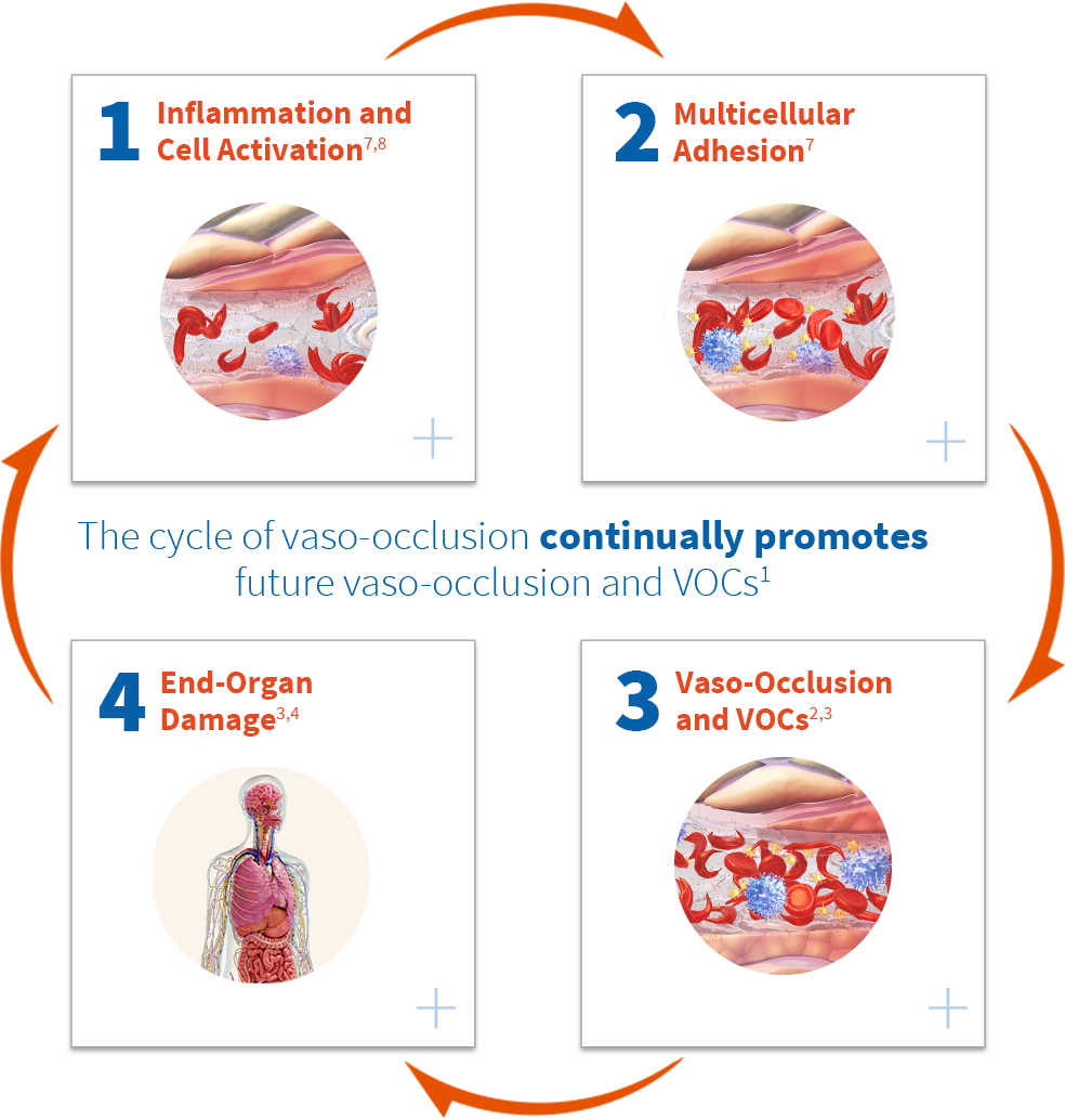The cycle of vaso-occlusion continually promotes future vaso-occlusion and VOCs